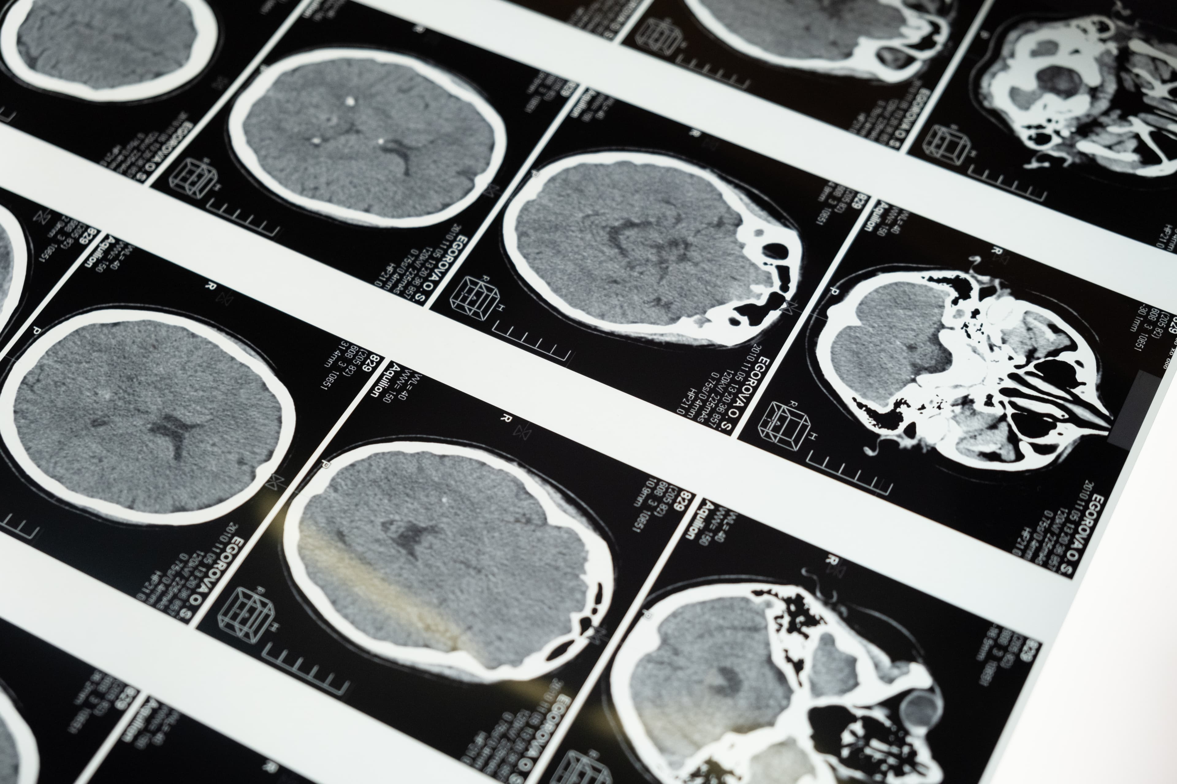 CT Scan